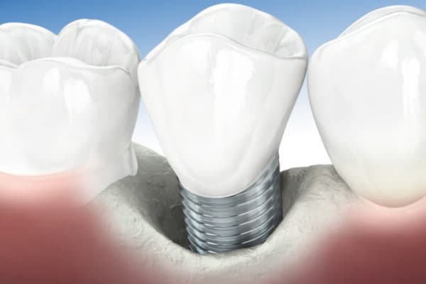 zfz_periimplantitis_web