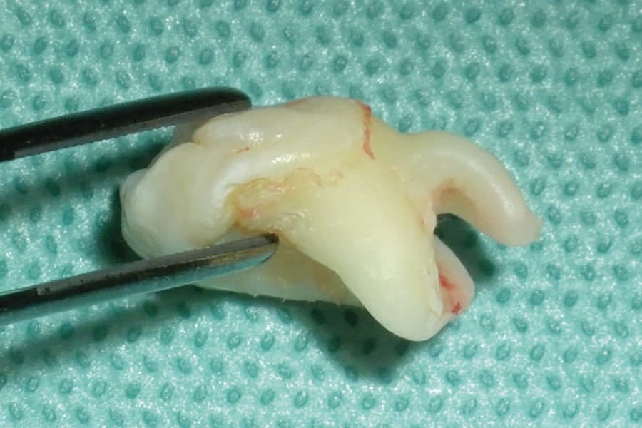 Wolf mectron Extraktion Molar