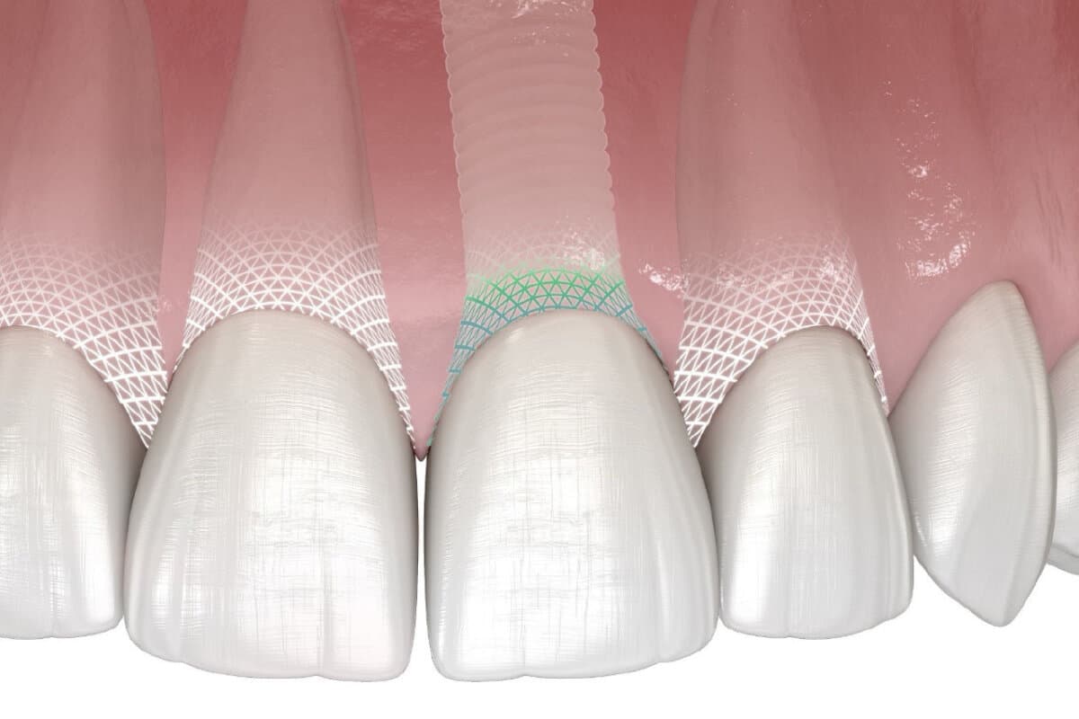 Symbionic Teeth: Der Zahnersatz mit der Schutzbarriere